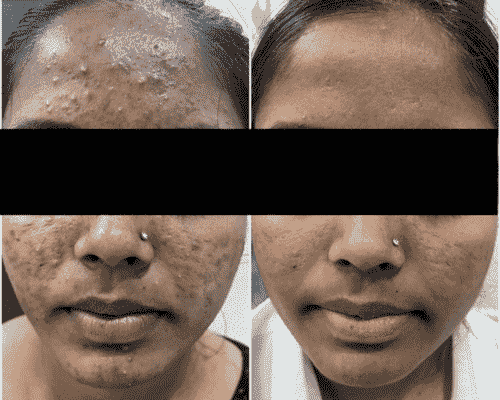 Acne Treatment Before After