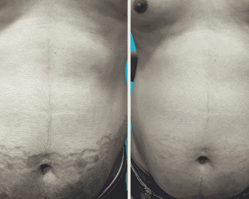 Stretch Marks Treatment Before After